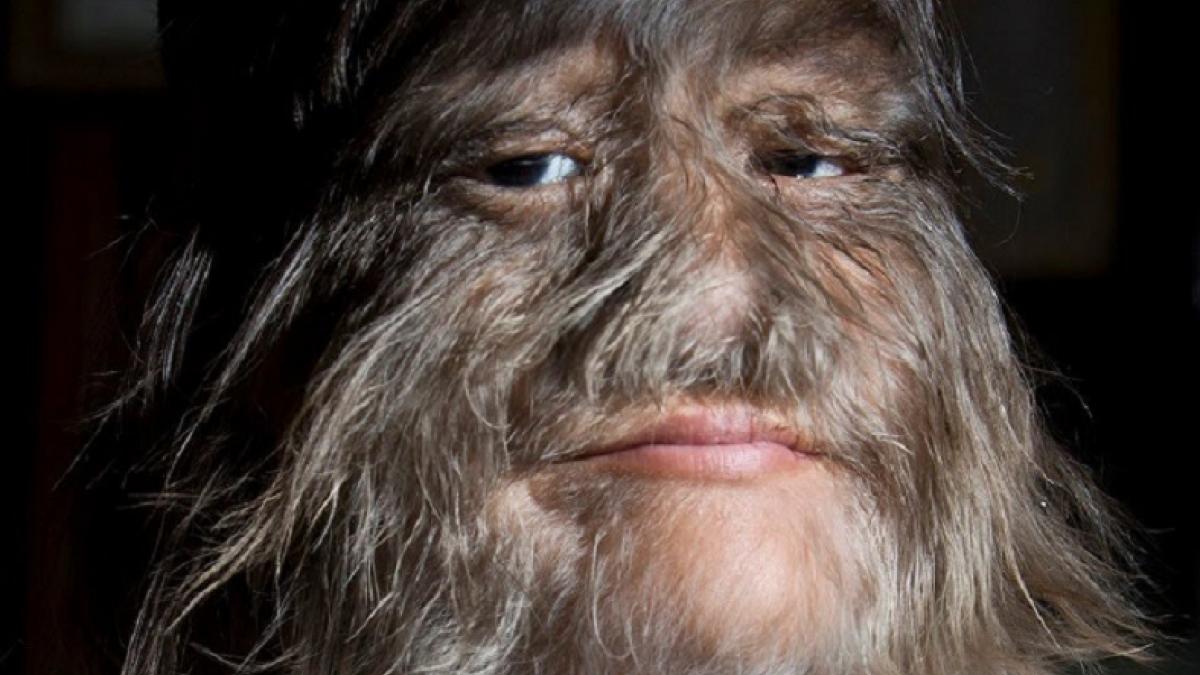 Самые страшные генетические аномалии, преследующие человека Самые страшные генетические аномалии, преследующие человека