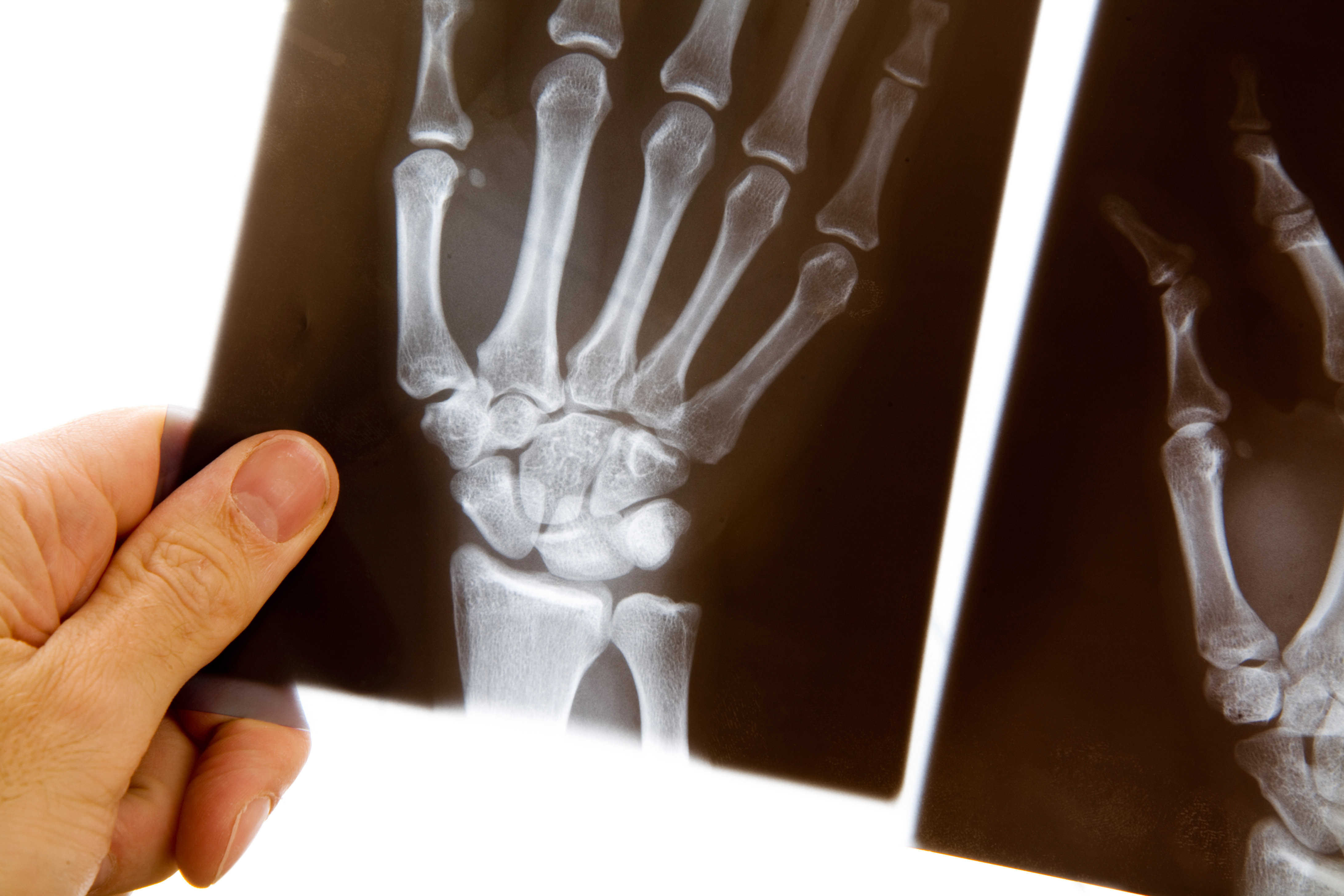 Рентгеновские снимки руки