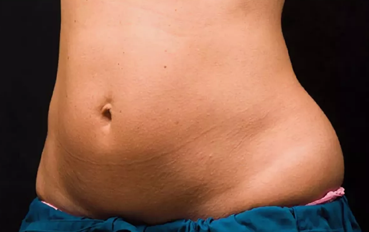 Висцелярный жир на животе у женщин фото