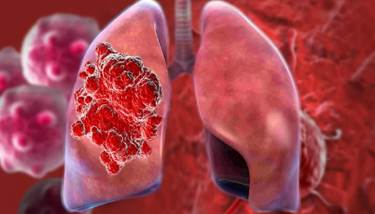 Онколог Печерица проинформировал, как не пропустить самый смертельный ...