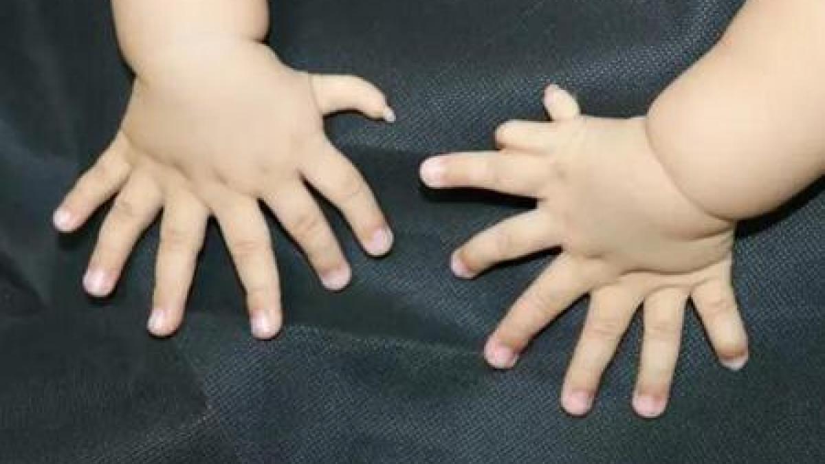В Китае родился младенец с 31 пальцем на руках и ногах Ребенок с 31 пальцем