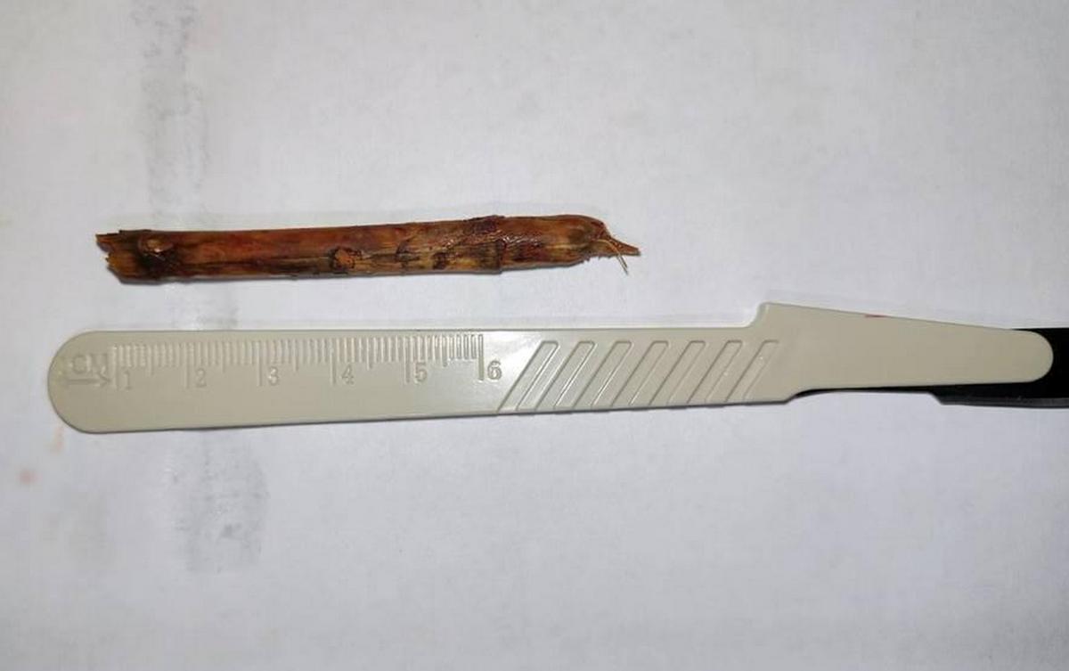 На Ставрополье женщина две недели проходила с 8-сантиметровой веткой ...